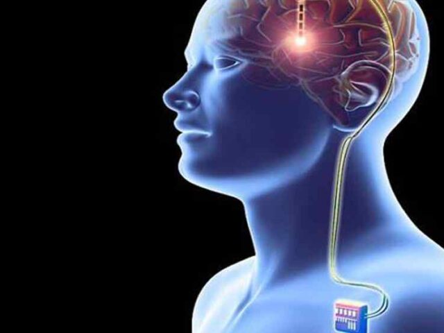 Nuevos tratamientos para el Párkinson: Estimulación Cerebral Profunda y Ultrasonidos de Alta Intensidad ganan terreno en España