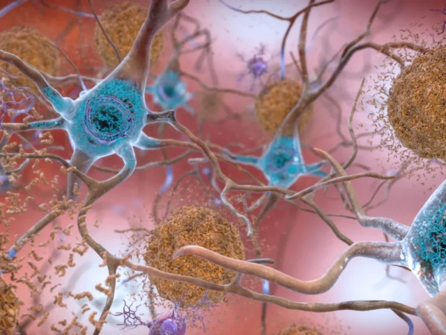 Una terapia reprograma las células del paciente para tratar el párkison