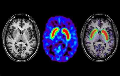 Cambios en el Cerebro de Personas con Párkinson Detectados por Resonancia Magnética
