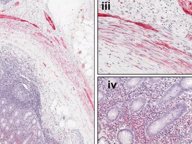 Una nueva investigación vincula el apéndice con la enfermedad de Párkinson