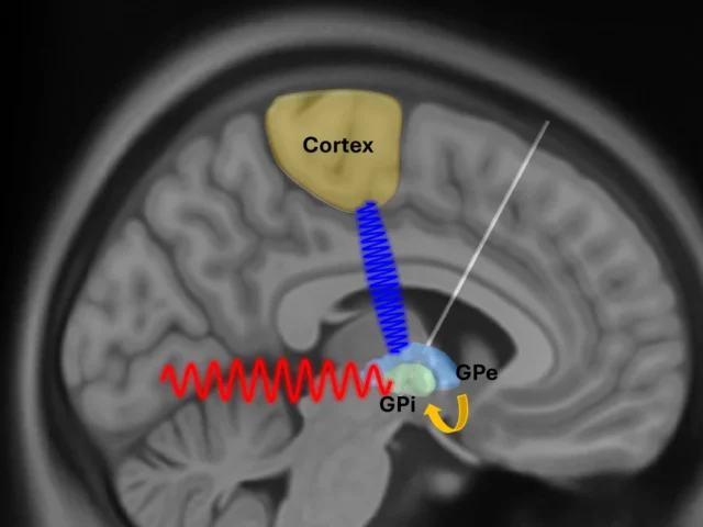 Descubrimiento en la actividad cerebral podría transformar el tratamiento del Párkinson